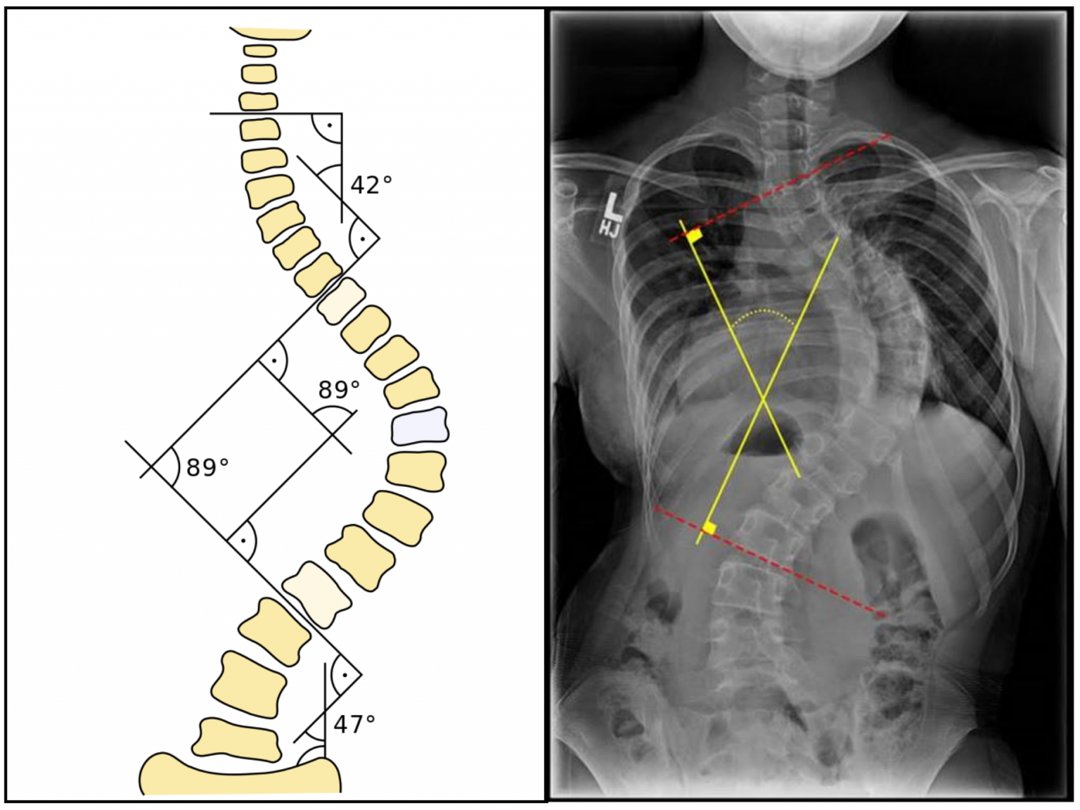 Угол Кобба степени сколиоза. Угол кифоза рентген. Измерение сколиоза по коббу. Степени сколиоза позвоночника по коббу.