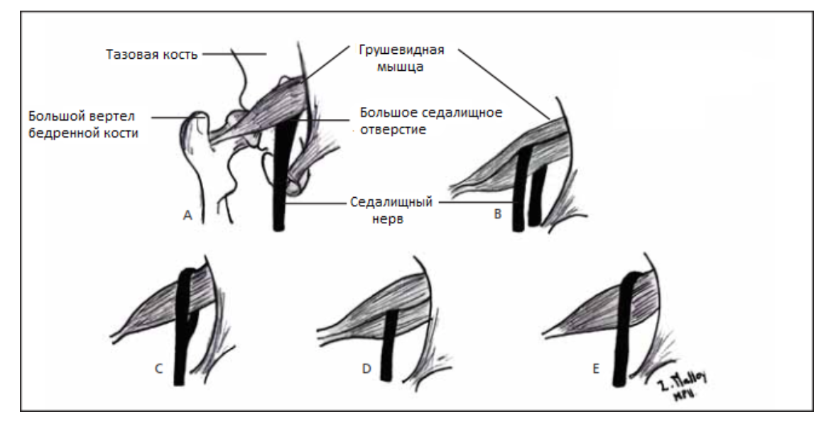 Грушевидная мышца бедра. Грушевидная мышца. Грушевидная мышца кт анатомия. Синдром грушевидной мышцы мрт.