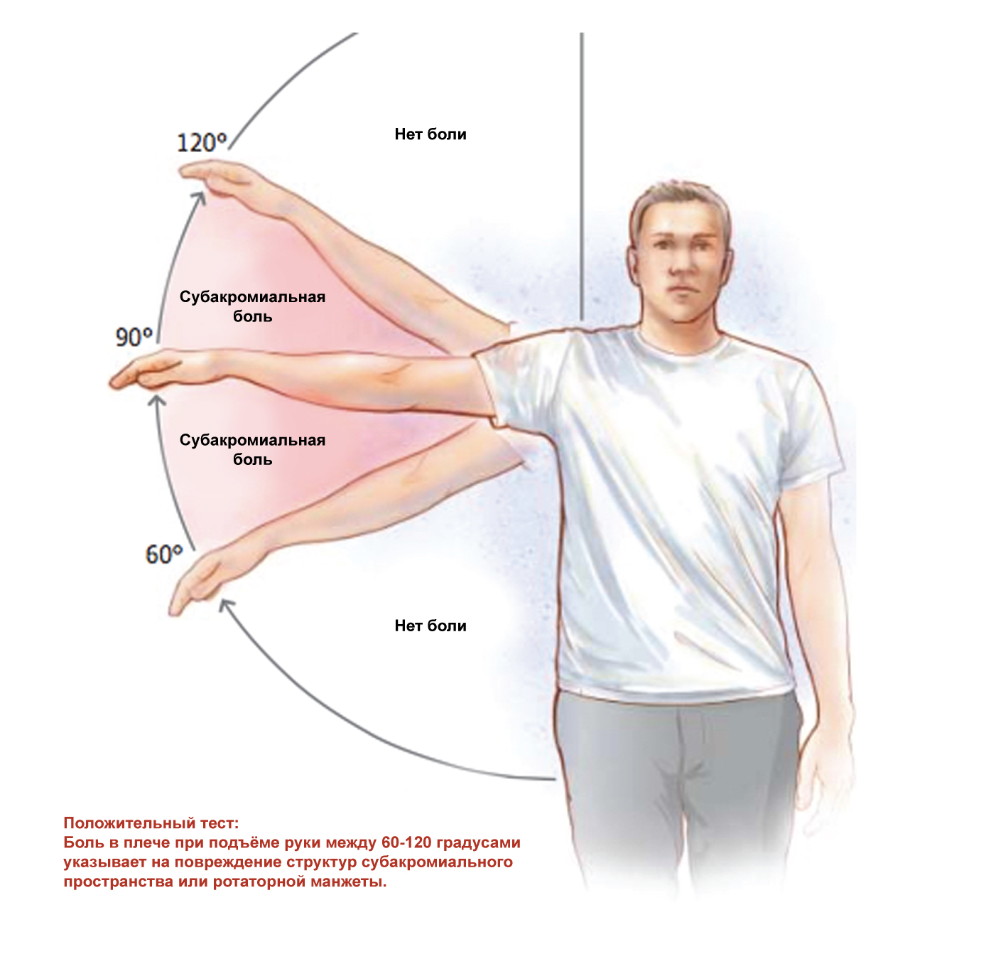 Сильно болит левое плечо. Субакромиальный синдром плечевого сустава ЛФК. ЛФК при импиджмент синдром правого плечевого сустава. Субакромиальный болевой синдром. Лечебная физкультура при импинджмент синдроме плечевого сустава.