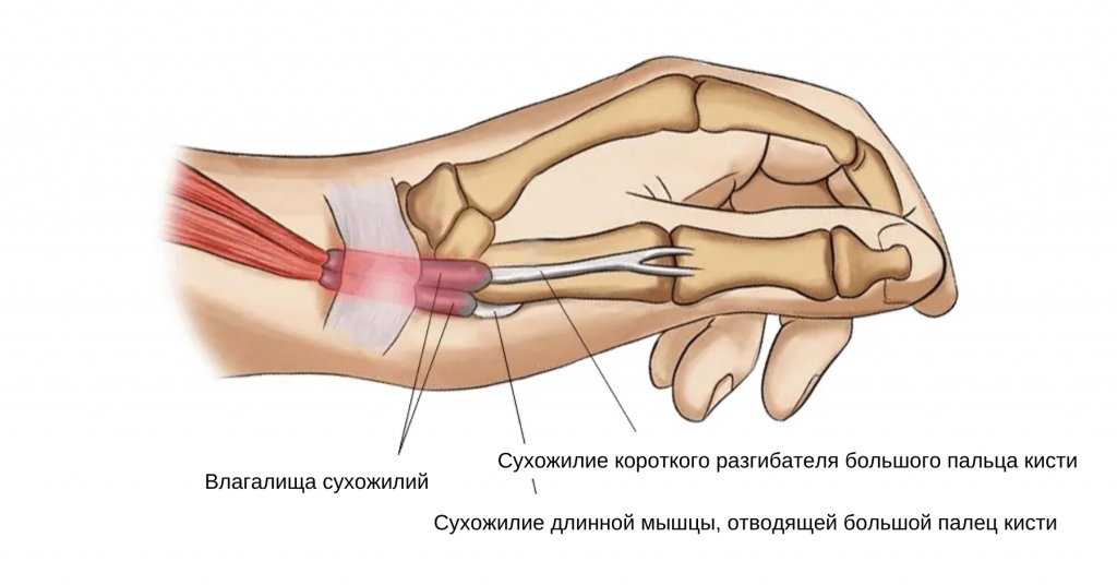 Шишка на руке: опасна ли гигрома и как ее лечить