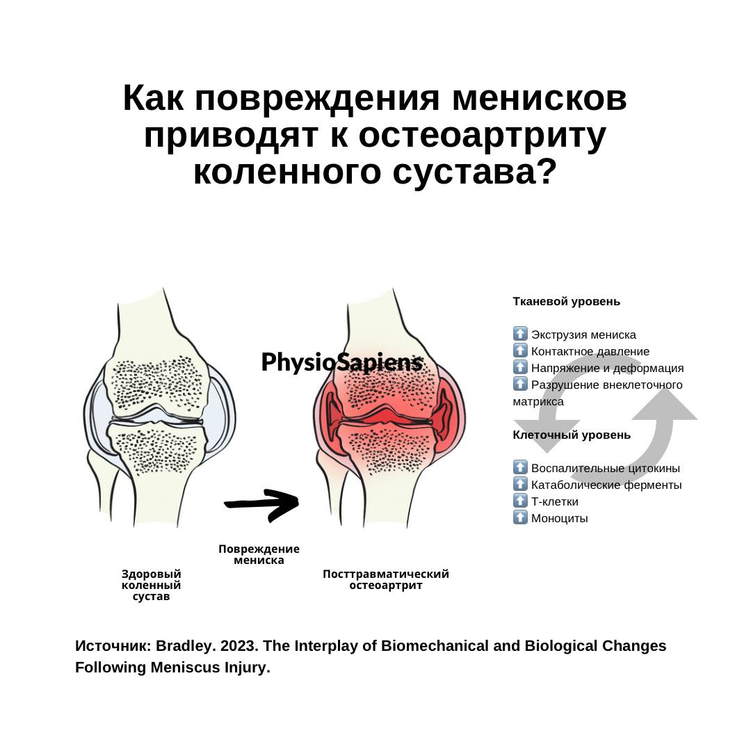 Как повреждения менисков приводят к остеоартриту коленного сустава?
