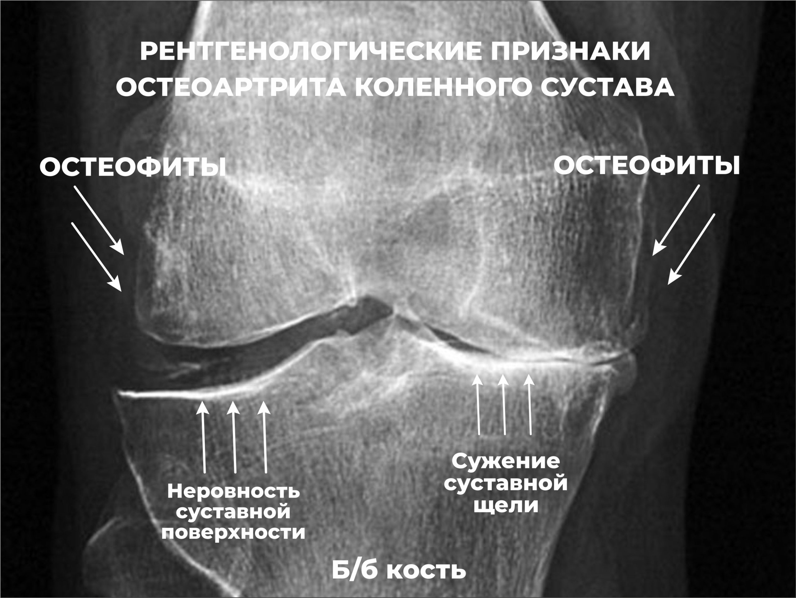 Оценка остеоартрита университетами Западного Онтарио и МакМастера (WOMAC)