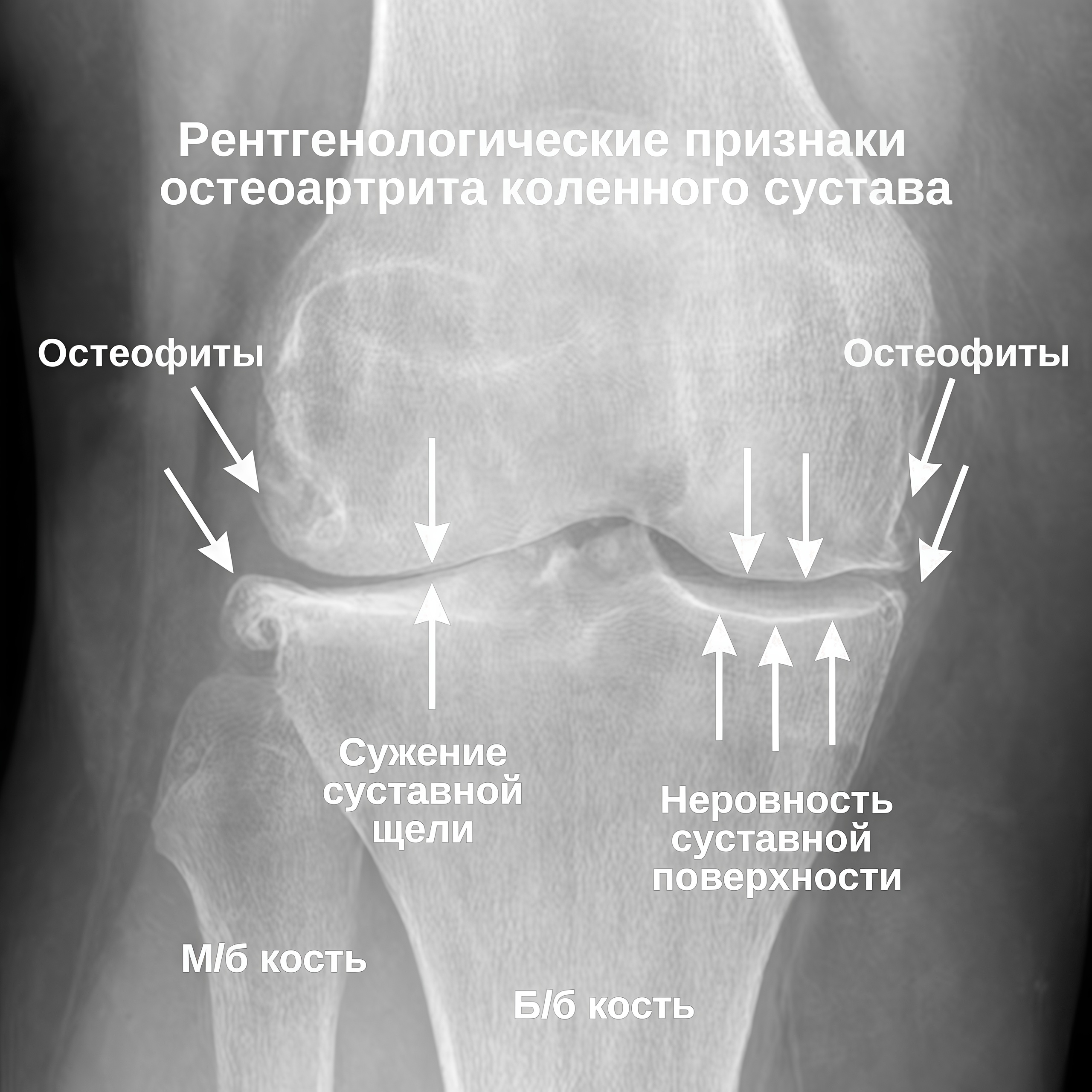 Оценка остеоартрита университетами Западного Онтарио и МакМастера (WOMAC)
