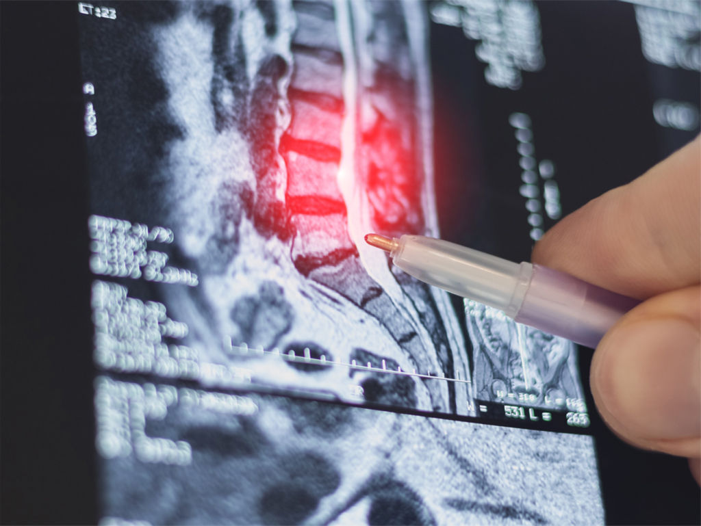 Сроки реабилитации после операции на позвоночнике