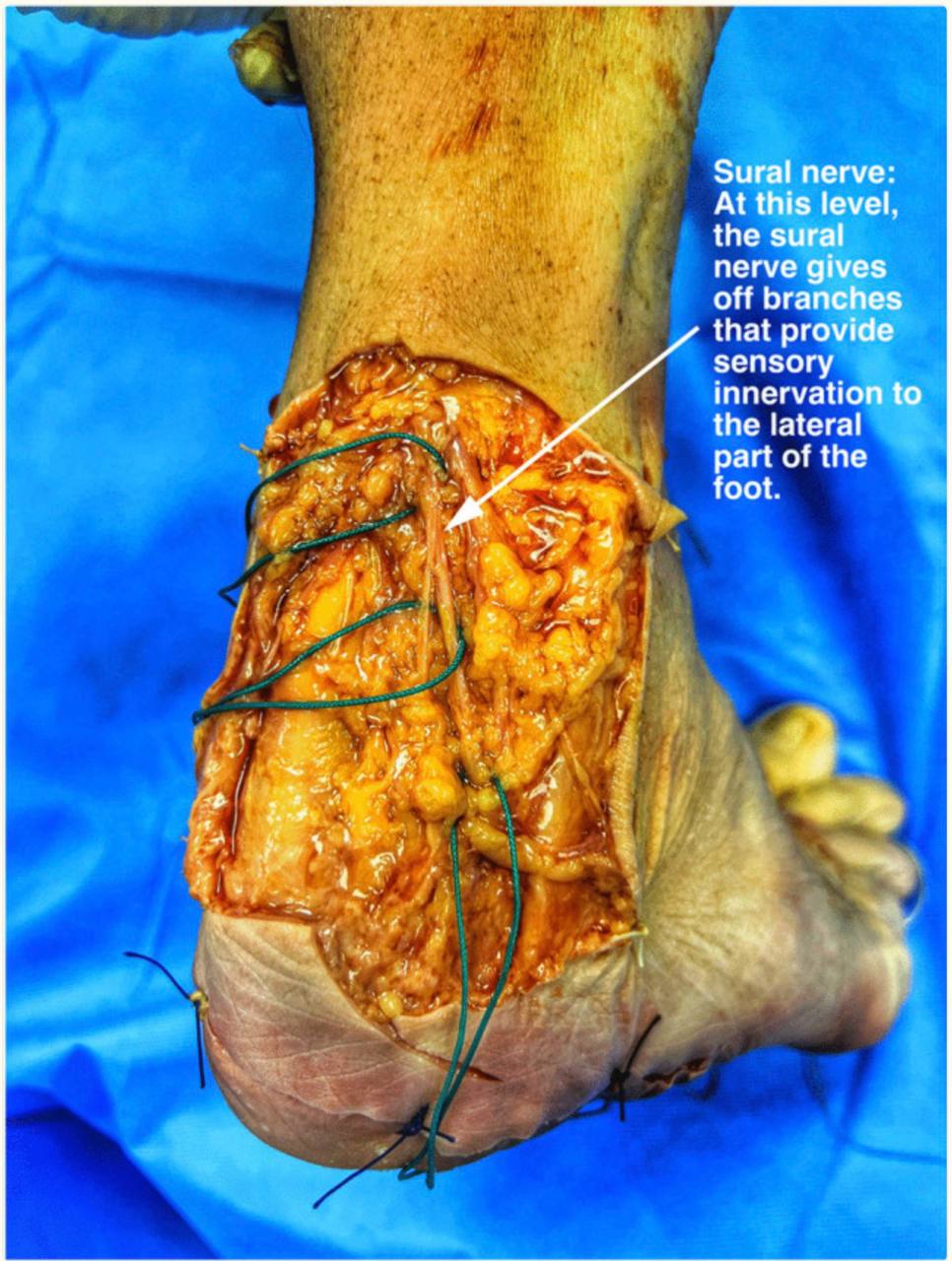 Обзор пальпации нервов при туннельных синдромах стопы и голеностопа