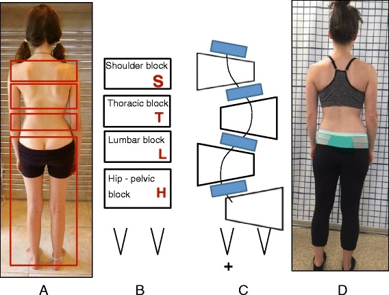 Сколиоз: диагностика, классификация и лечение