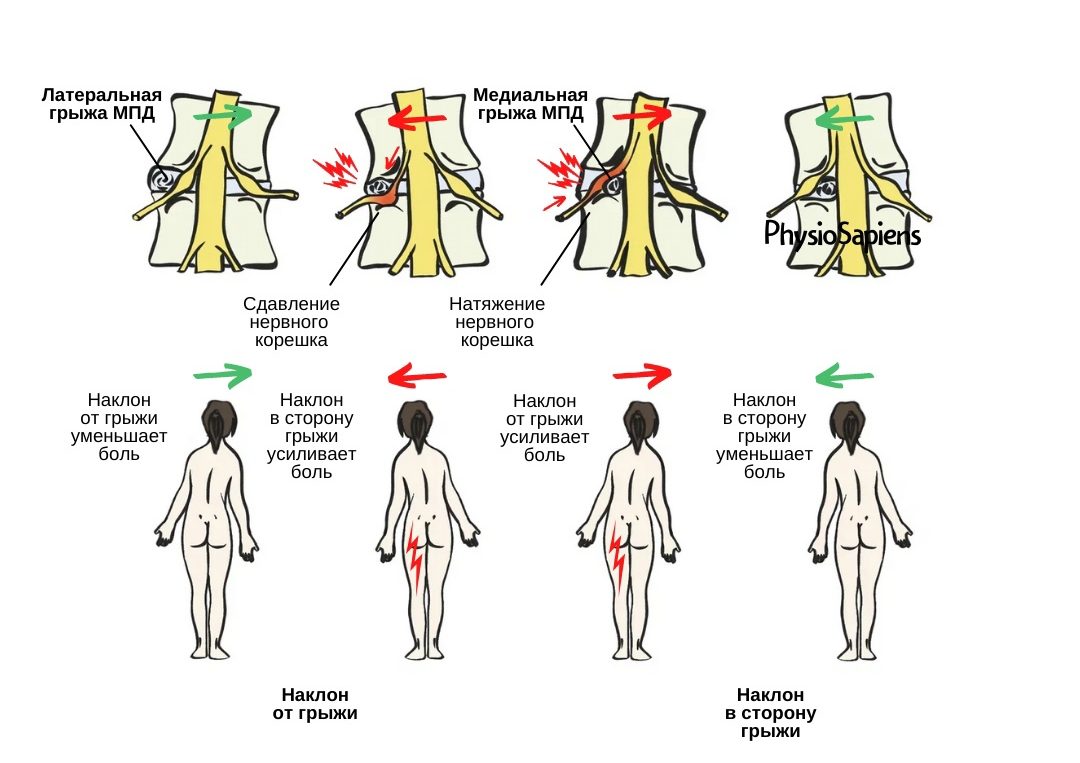 Корешковый синдром поясничного отдела позвоночника