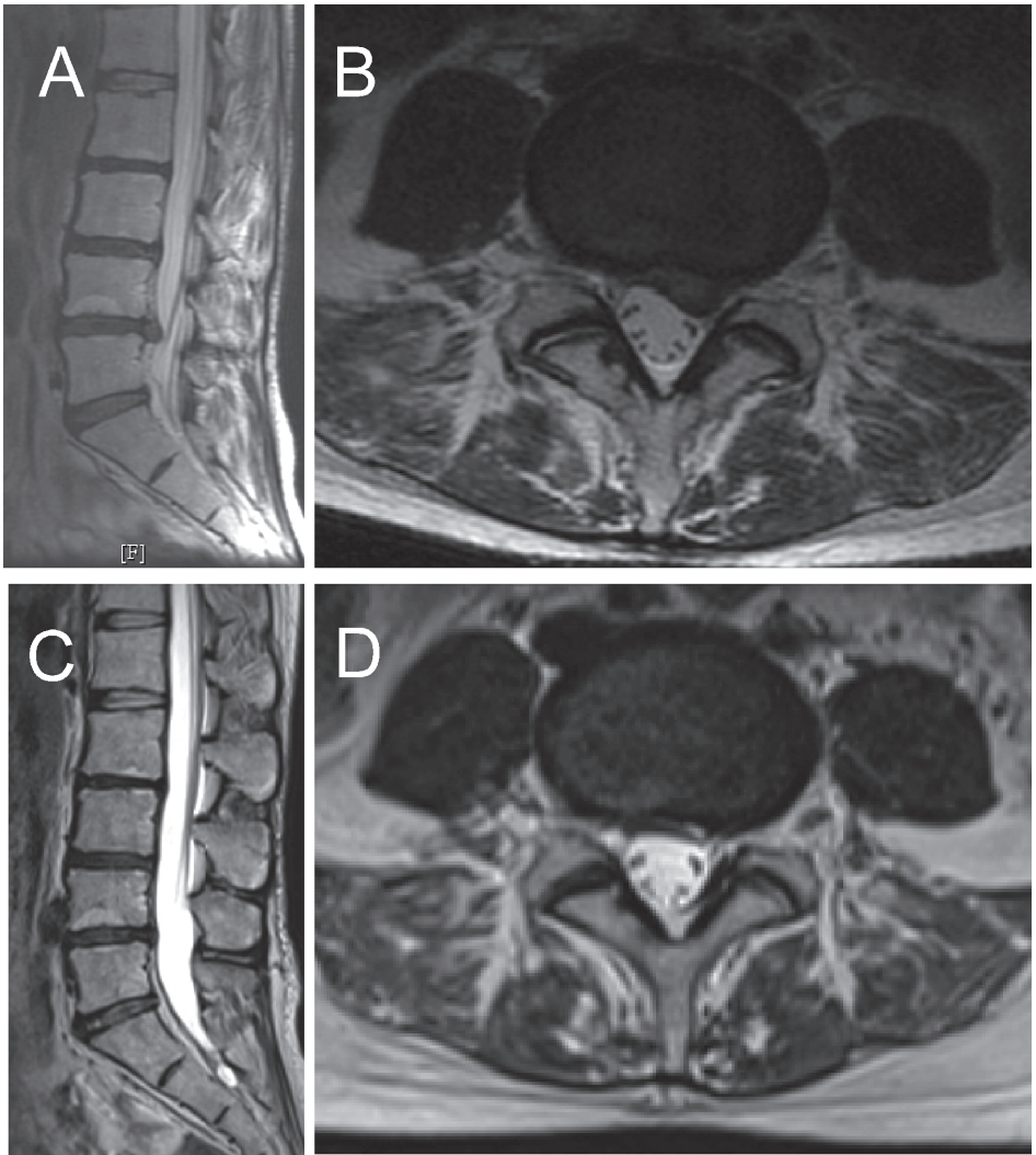 Резорбция грыжи межпозвонкового диска 