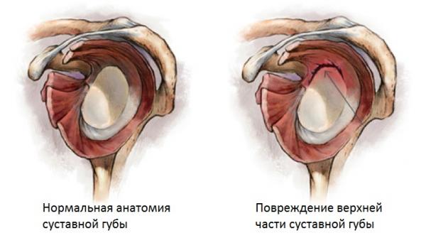 Повреждения суставной губы (в том числе SLAP – повреждения)